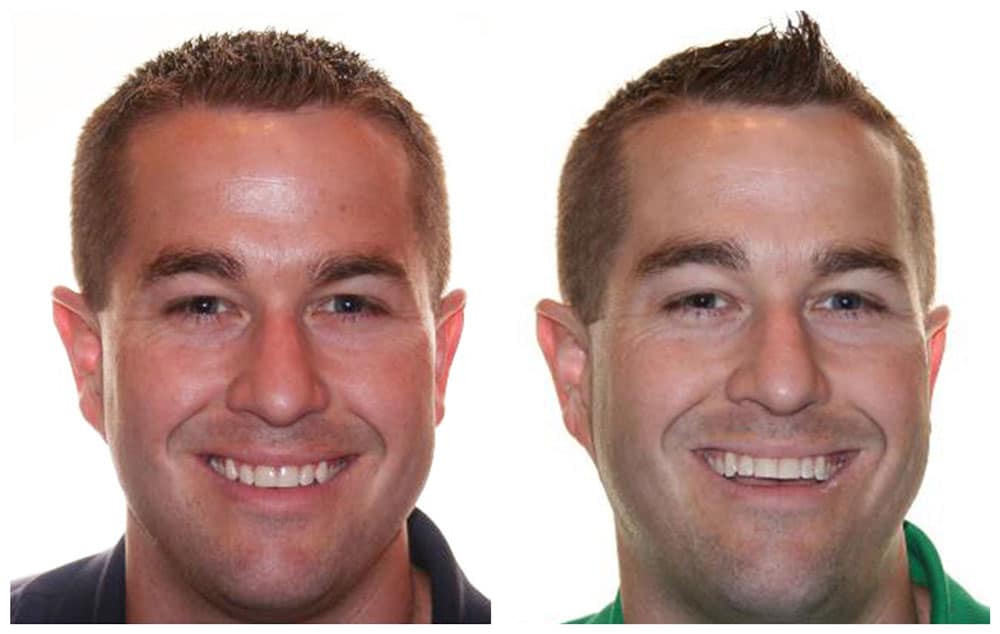 adult showing before and after invisalign