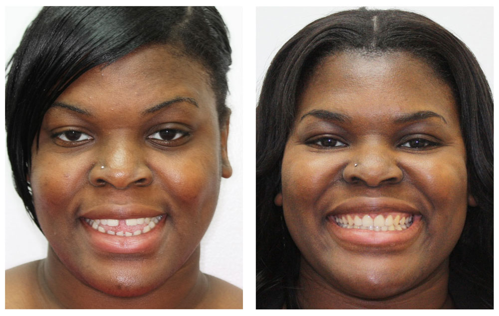 adult showing before and after invisalign