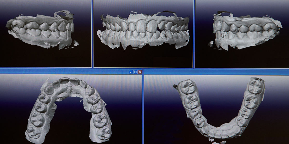 Digital Intraoral Scanner