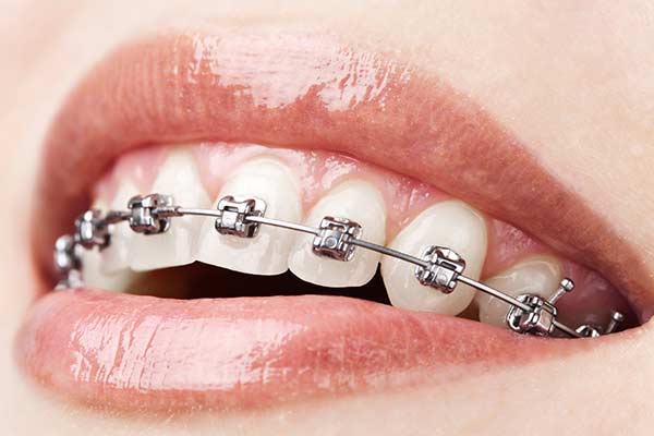 Braces Image