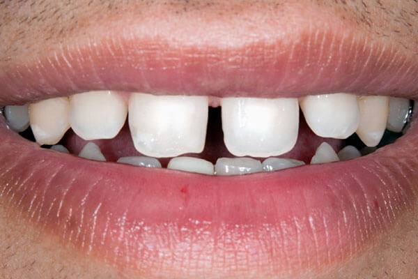 Gaps between teeth