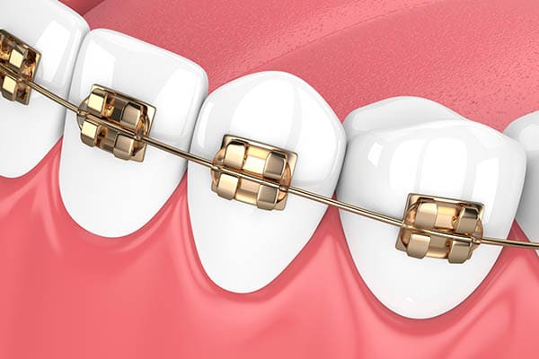 Gold Braces Photo