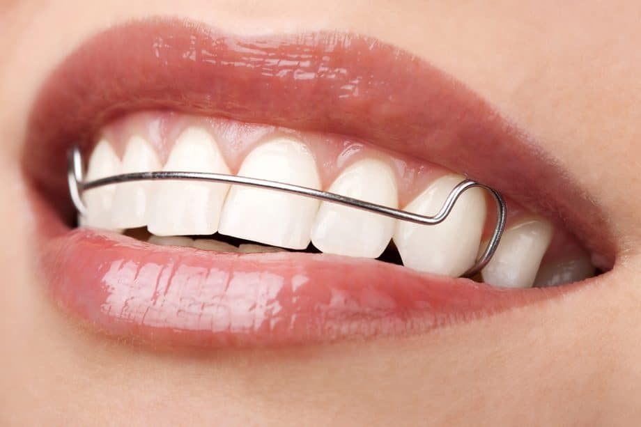 How Long Do You Really Need to Wear Your Retainer?