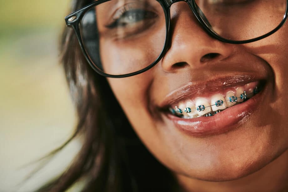 How Retainers Protect Your Smile Years After Braces