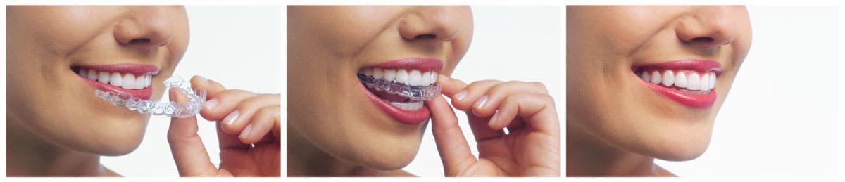 Invisalign® clear aligner