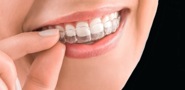 invisalign image