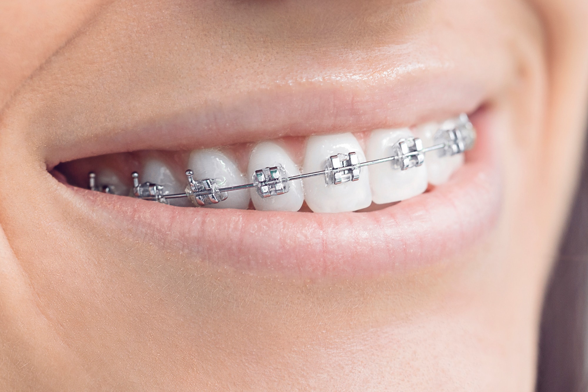 Metal Braces