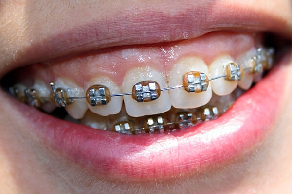 Metal braces to correct overbite