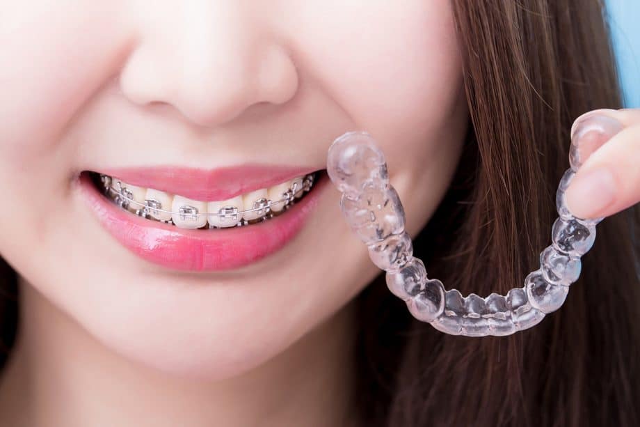 Phase 1 vs. Phase 2 Orthodontic Treatment: What Parents Need to Know