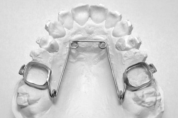 Lingual Braces