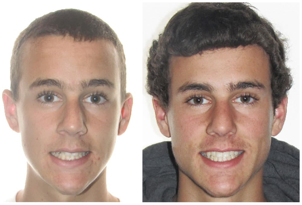 teen showing before and after invisalign