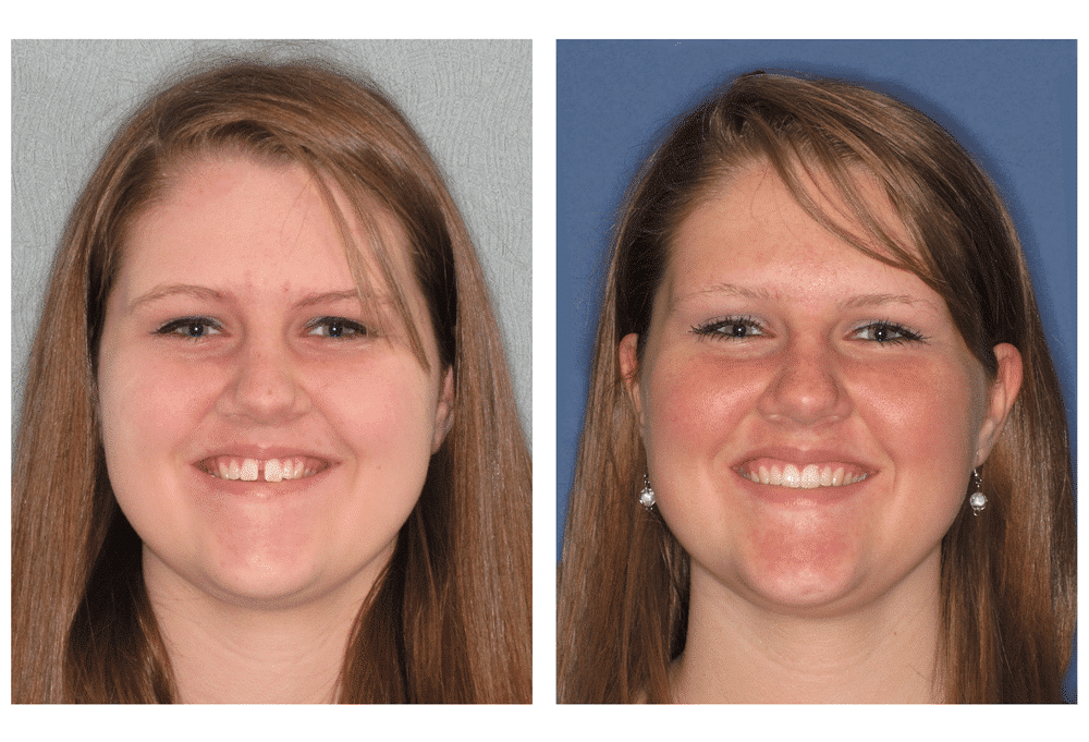 teen showing before and after invisalign